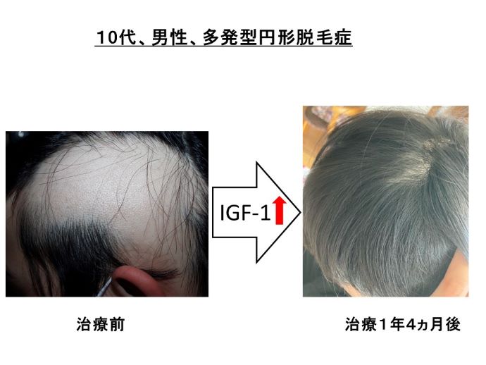 円形脱毛症　病院